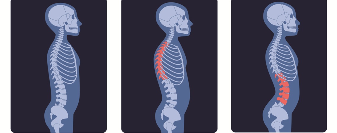 diverse Röntgenaufnahmen (nomal, Kyphose, Lordose) diverse Röntgenaufnahmen (nomal, Kyphose, Lordose)
